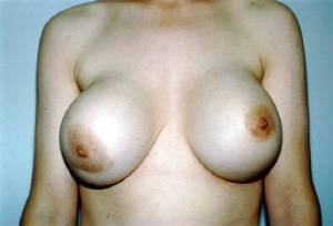 breast-capsular-contracture.jpg