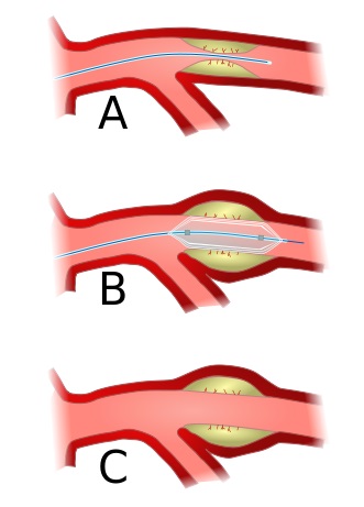 angioplasty-scheme.jpg
