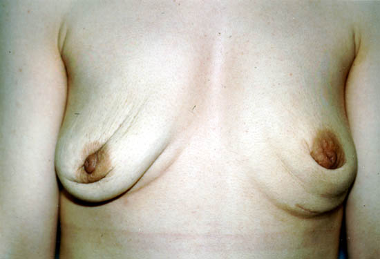 breast-implant-repture-removed.jpg