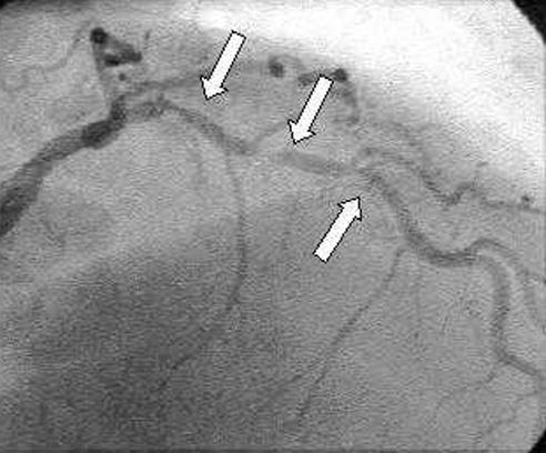 coronary-artery-constriction.jpg