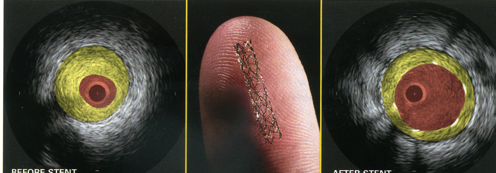 stent.jpg