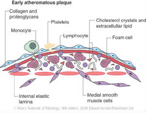 What Clogs Coronary Arteries: The Composition of Plaque