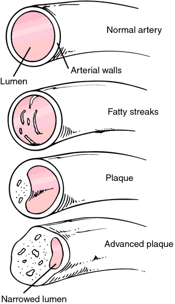 The Cholesterol Myth, and Fixes